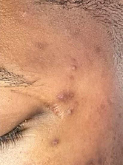 Client's cheek in July 2021, showing active breakouts, dark spots, and a compromised skin barrier.